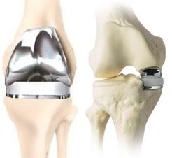 Das künstliche Kniegelenk - Kniegelenksprothese